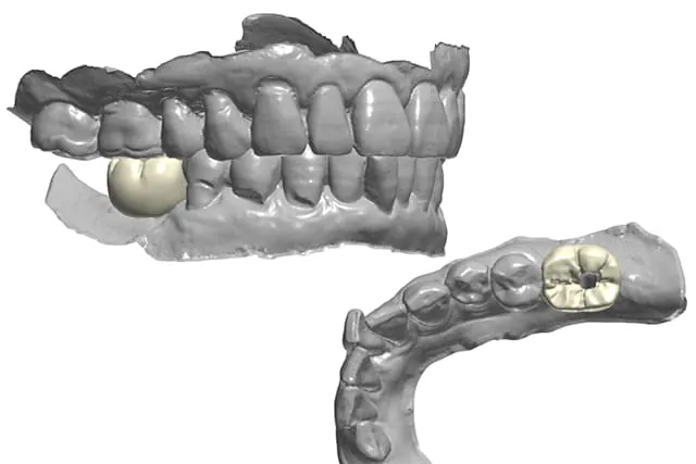 implant-premium-ceramic2