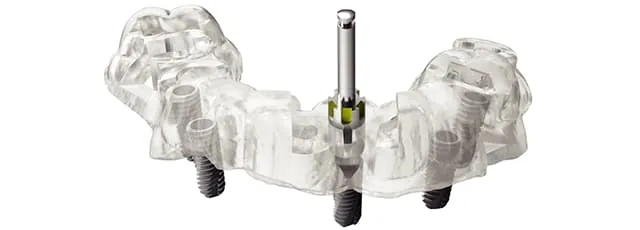 implant-premium-oneguide1