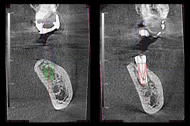 implant-premium-oneguide3
