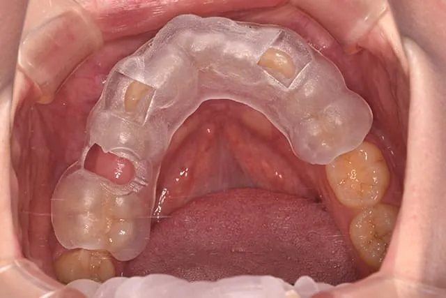 implant-premium-oneguide4