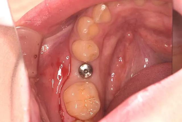 implant-premium-oneguide5