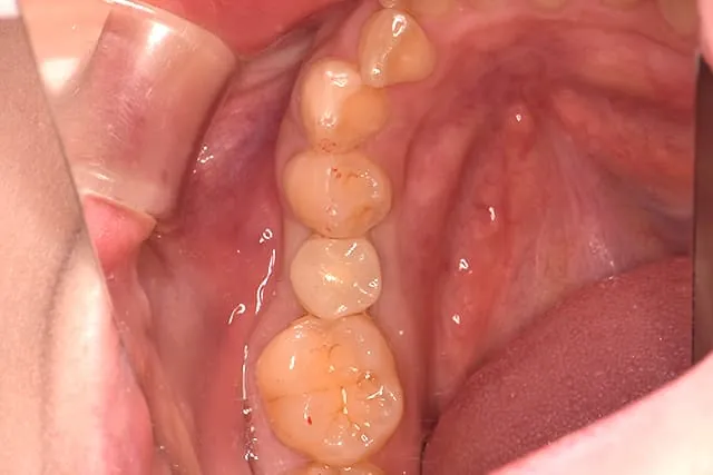 implant-premium-oneguide6